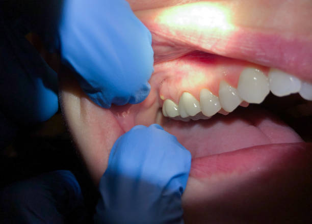 Best Emergency Gum Treatment in Atlantic City, NJ